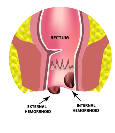 hemorrhoids